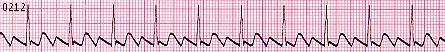 Atrial Flutter