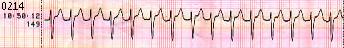 Supra Ventricular Tachycardia