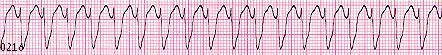 Ventricular Tachycardia - Wide Complex Tachycardia