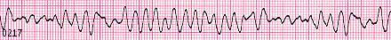 Ventricular Fibrillation