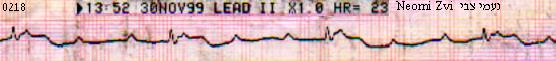 Complete Atrio-Ventricular Block = 3rd Degree AVB