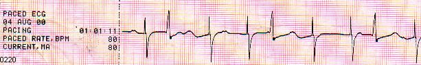 ECG0220 - Demand Pacemaker, CAVB