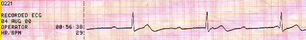 ECG0221 - CAVB