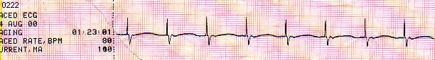 Low Ventricular Response to Pacing - underline Asystole