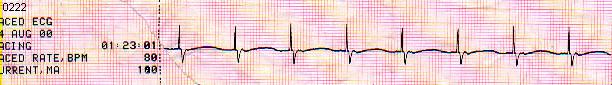Low Ventricular Response to Pacing - underline Asystole