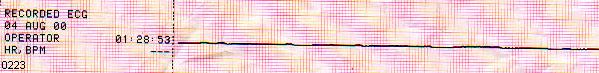 One of the 3 event of Asystole