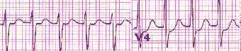 SupraVentricular Tachycardia