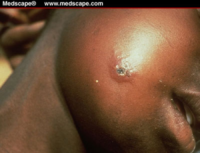 anthrax_lesion_2.jpg
