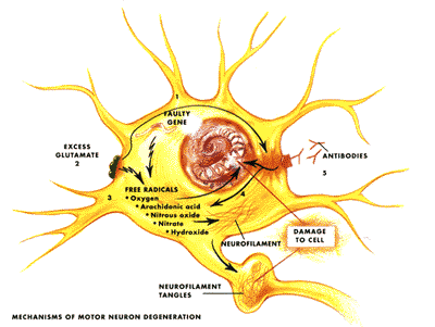 ALS is probably triggered by a combination of one's genes and a variety of environmental factors.