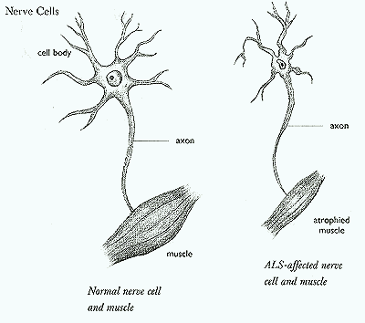 Normal and ALS-affected Nerves