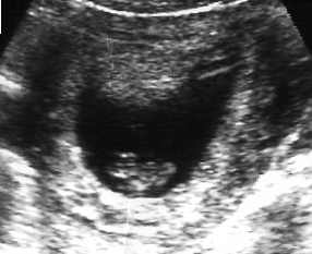 Baby's 1st ultrasound