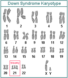 down syndrome chromosomes