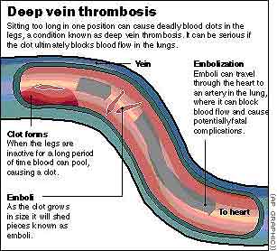 DVT�S