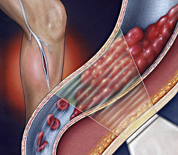 dvt