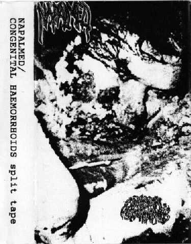 split tape with CONGENITAL HAEMORRHOIDS, 1996