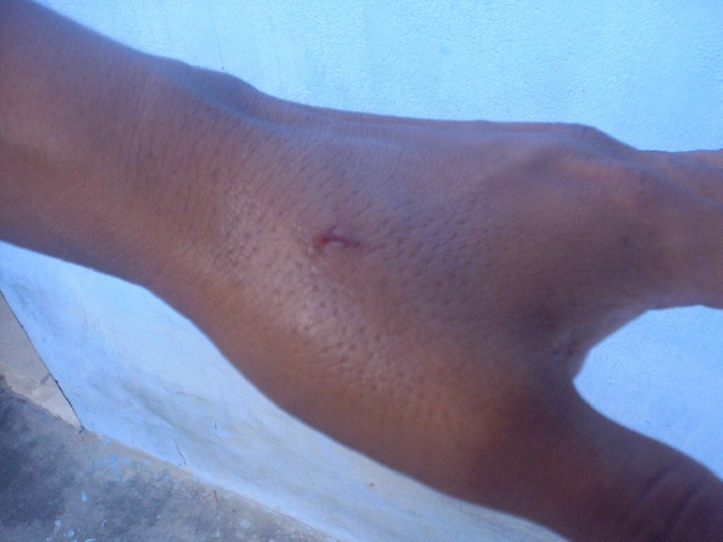 Wound caused for a 4 inch stingray