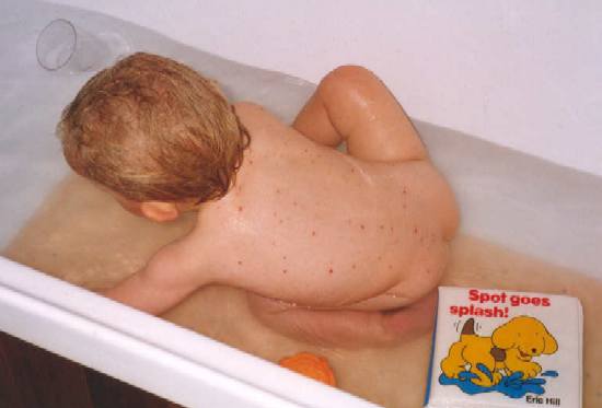 Caitlin's Spotty Back, June 1999