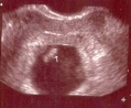 1st Ultrasound Pic