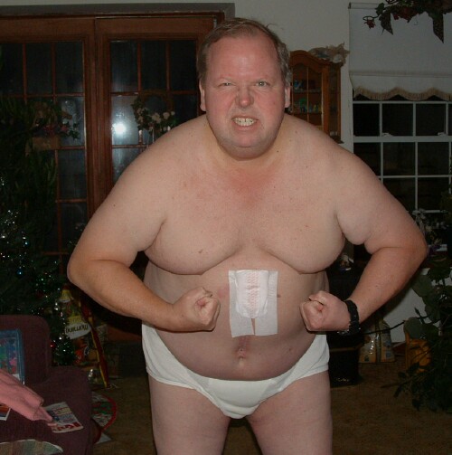 Chuck 2 months post-op