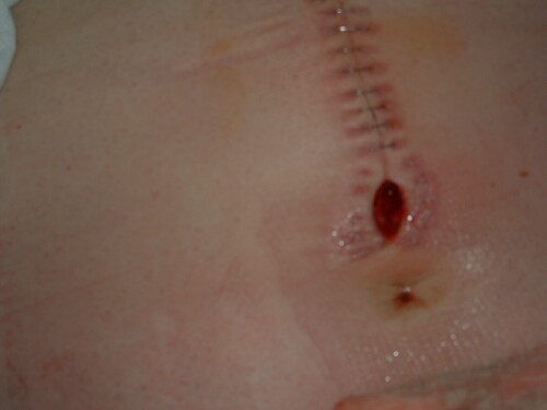 November 23rd-25th, 2002&nbsp; A little over one week post-op.
