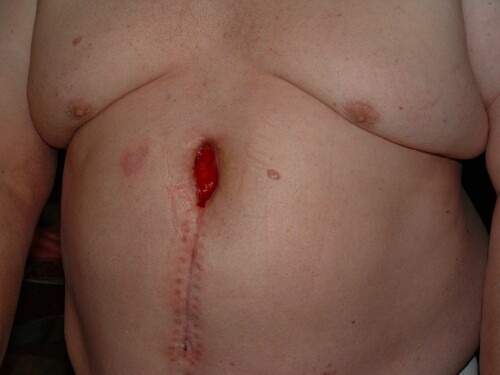 7 weeks post-op