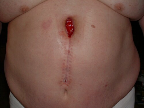 January 3, 2003 7 weeks post-op