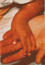 Thalidomide Hand