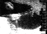 the Baby's foot