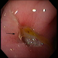 Ulcer
