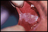 Leukoplakia