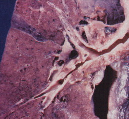 Non-smokers Lung