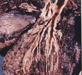 Smokers Lung