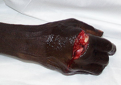 The effects of trying to catch a blade of a machete.