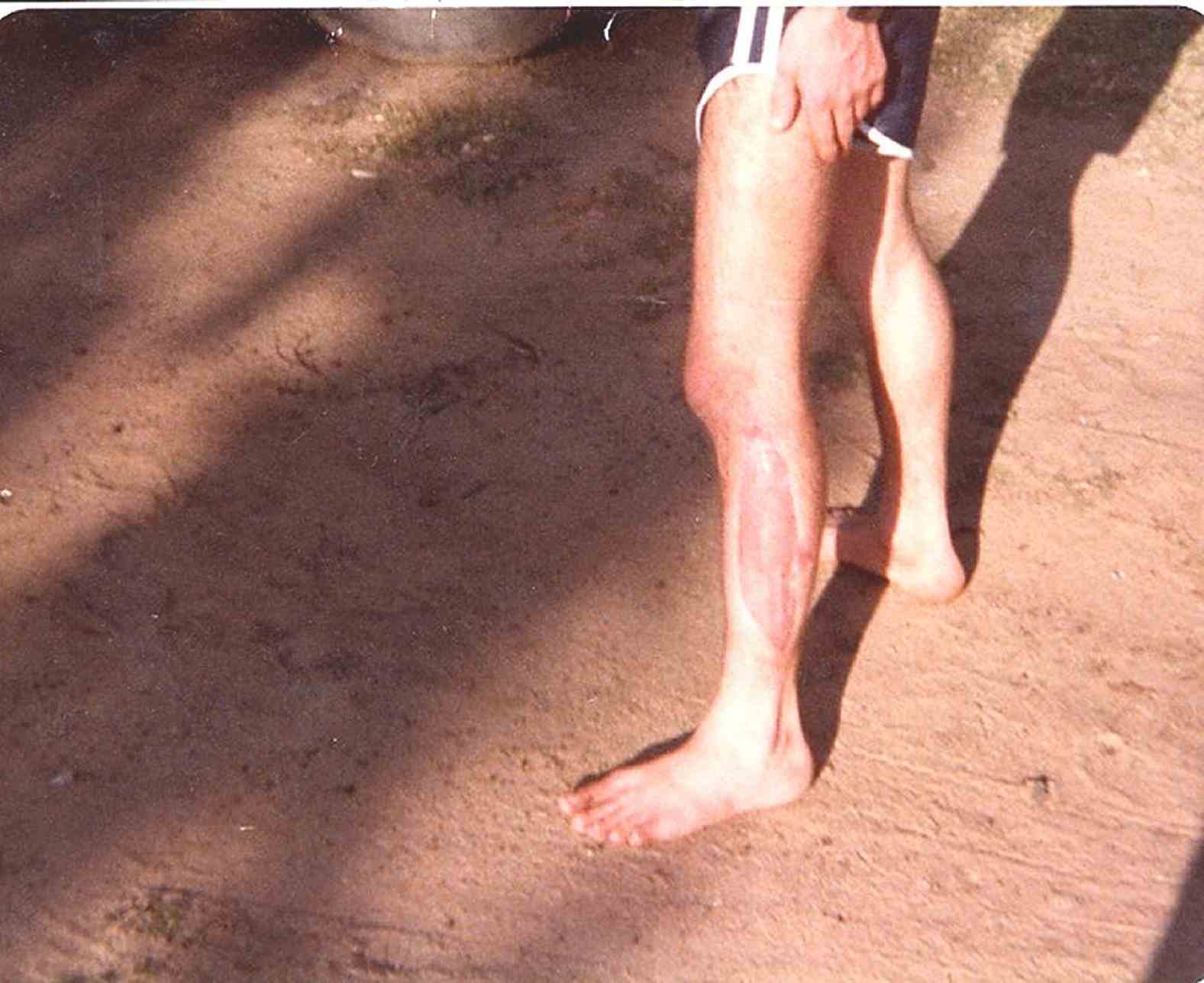 degloving injury left calf.