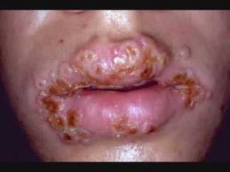 labios infectados