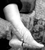 Foot binding results in feet shaped like high-heeled shoes.