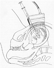 Prelievo di Liquido Amniotico
