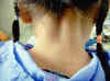AD_posterior_neck.jpg (7255 bytes)