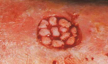 microinjertos_sobre_varicosa.jpg (17397 bytes)