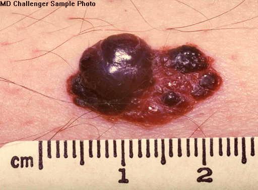 Malignant Melanoma