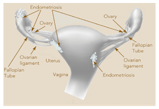 endometriosis