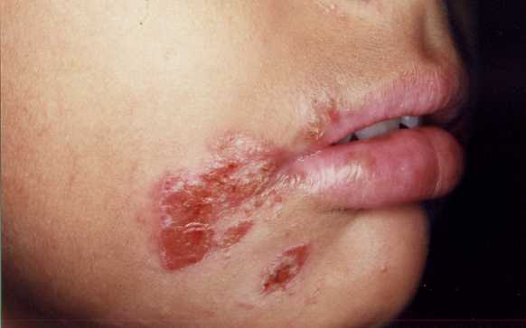 Rash : Check Your Symptoms and Signs – MedicineNet