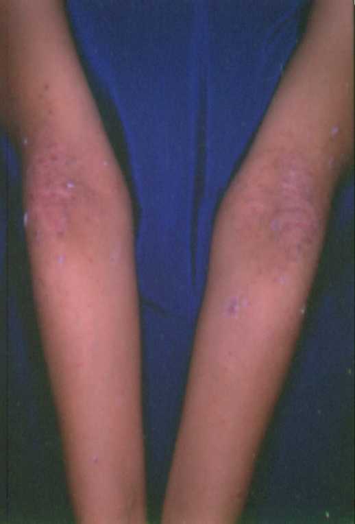 Atopichesky la dermatitis al niño en 1 año