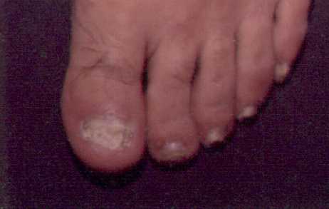 El hongo de las uñas al tratamiento las manos