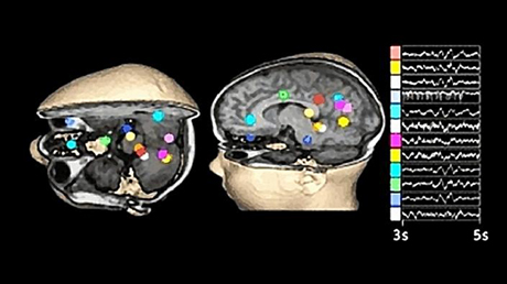 Mediante tcnicas de computacin se puede mapear la actividad elctrica del cerebro