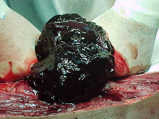 Trombo Aneurismatico