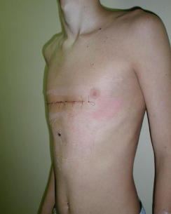 El Final del Carinatun