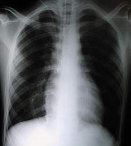 Rx PA durante terapia Intensiva