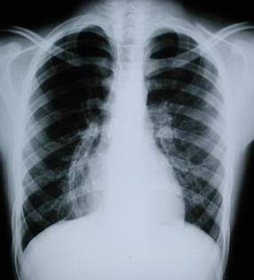 Rx post extubacion endotraqueal