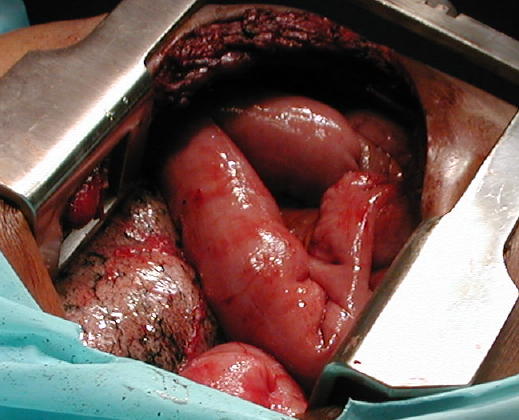 Al abordar la cavidad pleural se demuestra el contenido de asas delgadas iendotoracicas